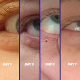 TagPal Easy Skin Tag Remover